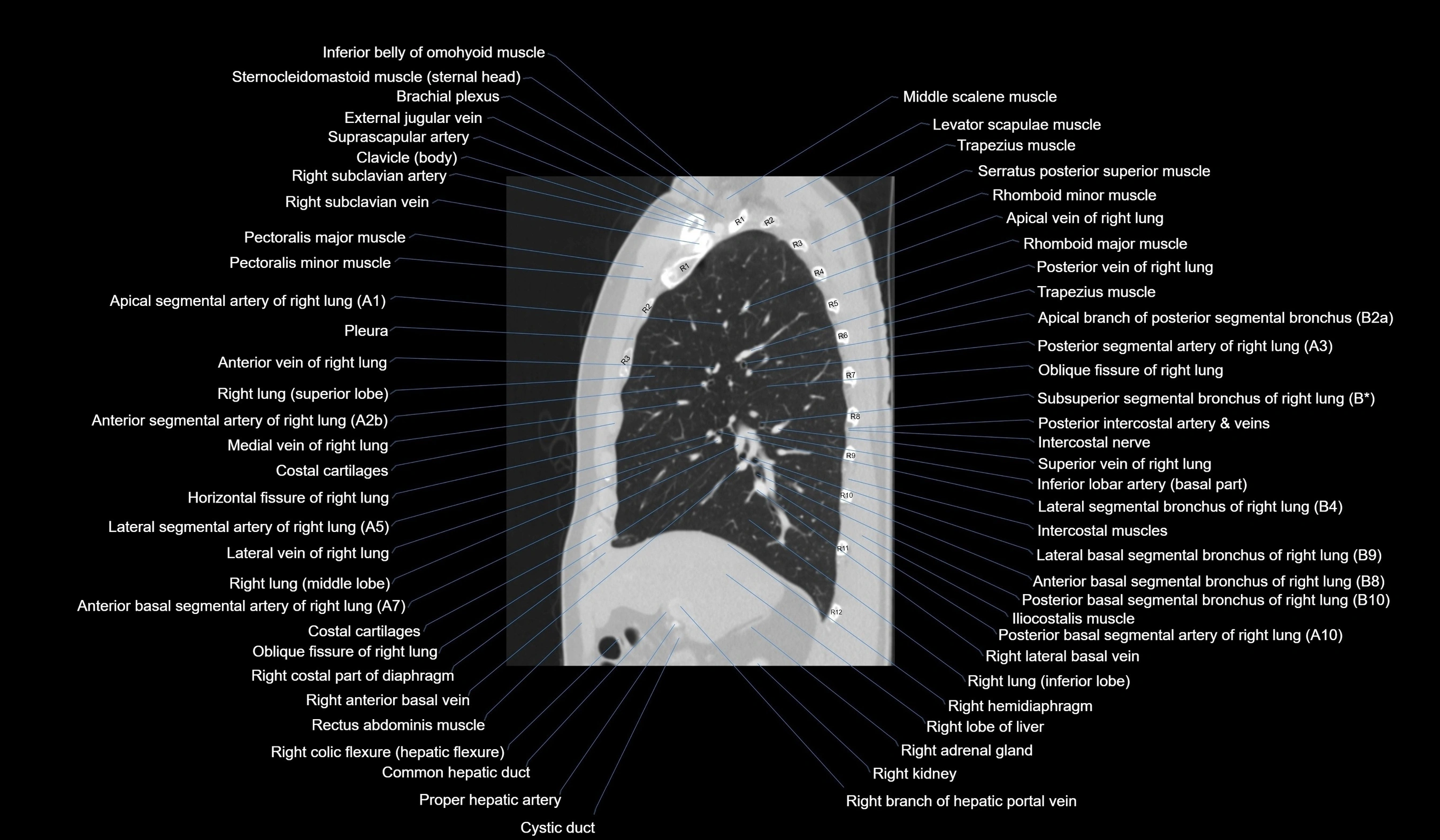 CT chest (thorax) labelled sagittal cross sectional anatomy radiology image-00052.webp